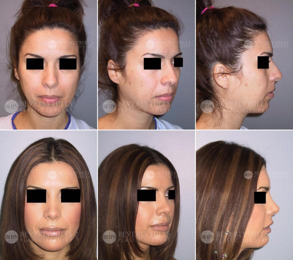 Beverly Hills Plastic Surgery gallery image 461