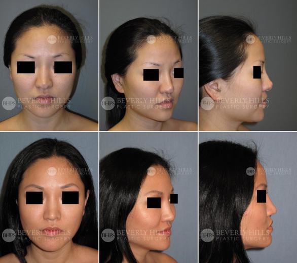 Beverly Hills Plastic Surgery gallery image 466