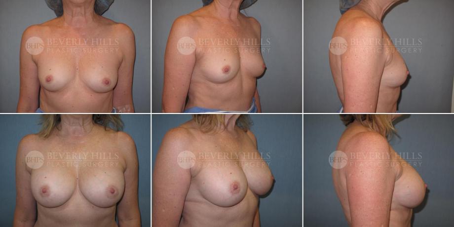 Beverly Hills Plastic Surgery gallery image 470
