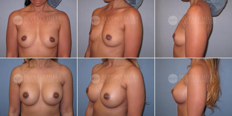 Beverly Hills Plastic Surgery gallery image 474