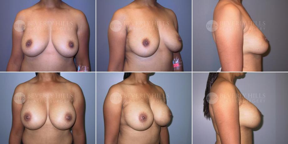 Beverly Hills Plastic Surgery gallery image 495